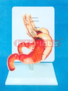 DESK TYPE HUMAN COMMON PATHOLOGIES OF STOMACH MODEL WITH DESCRIPTION PLATE